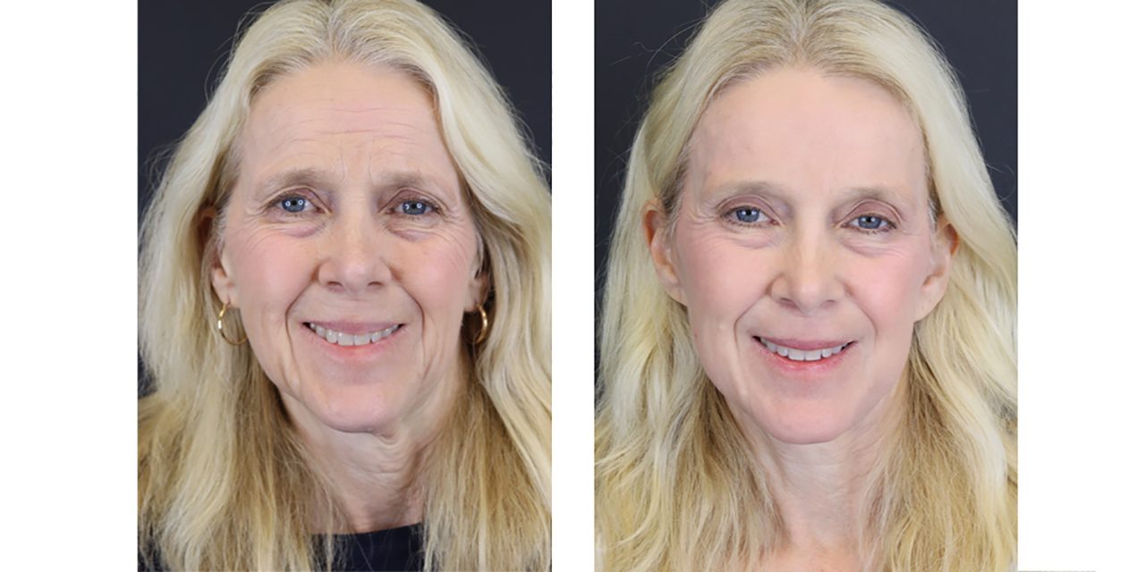 Dr Raggio The Undetectable Facelift | About Town